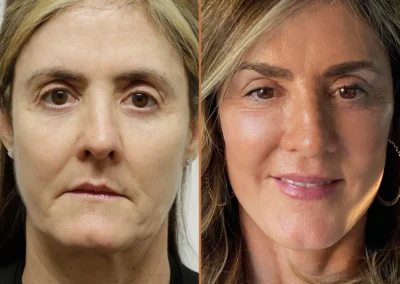 Neck Lift before and after photos by Sherber and Rad in Washington, DC