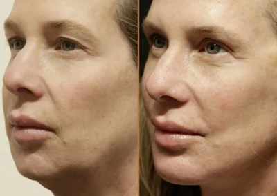 Neck Lift before and after photos by Sherber and Rad in Washington, DC