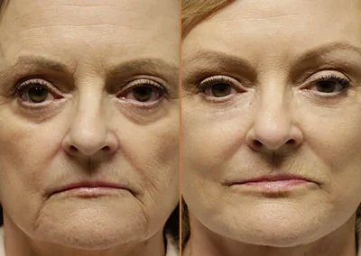 Neck Lift before and after photos by Sherber and Rad in Washington, DC
