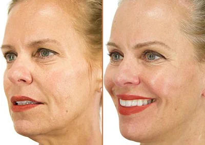 Neck Lift before and after photos by Sherber and Rad in Washington, DC