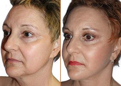 Neck Lift before and after photos by Sherber and Rad in Washington, DC