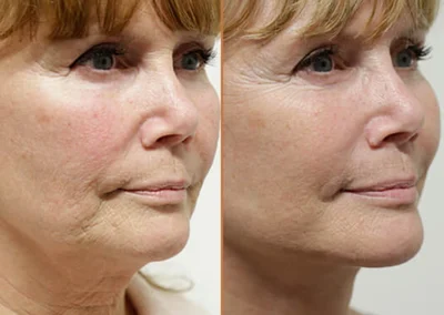 Neck Lift before and after photos by Sherber and Rad in Washington, DC