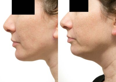 Neck Lift before and after photos by Sherber and Rad in Washington, DC