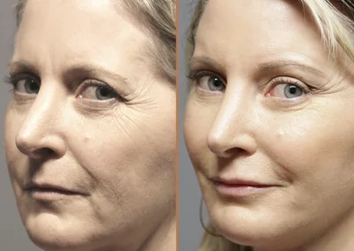 Neck Lift before and after photos by Sherber and Rad in Washington, DC