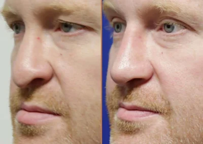 Rhinoplasty before and after photos by Sherber and Rad in Washington, DC