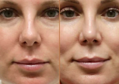 Rhinoplasty before and after photos by Sherber and Rad in Washington, DC