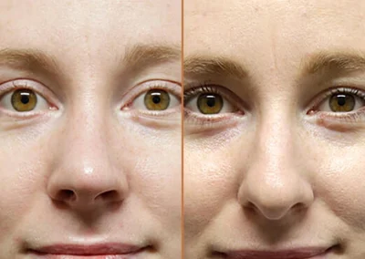 Rhinoplasty before and after photos by Sherber and Rad in Washington, DC