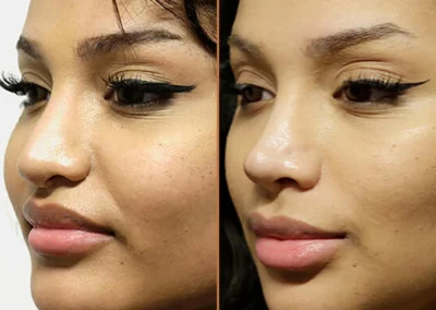 Rhinoplasty before and after photos by Sherber and Rad in Washington, DC