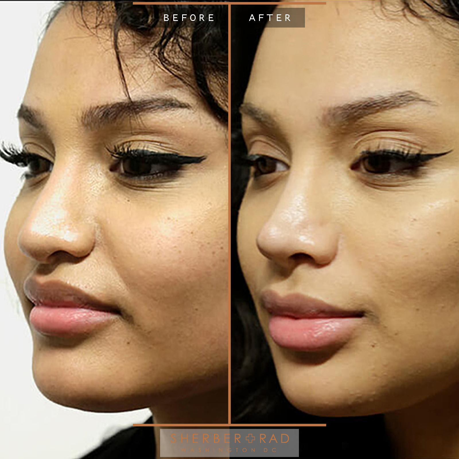Rhinoplasty before and after photos by Sherber and Rad in Washington, DC