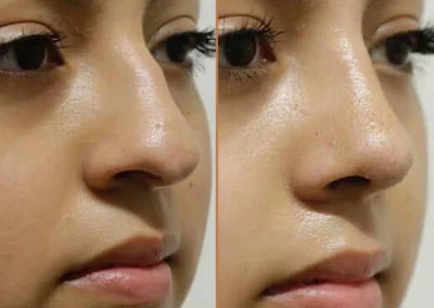 Rhinoplasty before and after photos by Sherber and Rad in Washington, DC