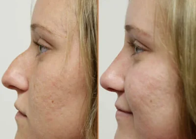 Rhinoplasty before and after photos by Sherber and Rad in Washington, DC