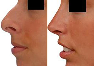 Rhinoplasty before and after photos by Sherber and Rad in Washington, DC