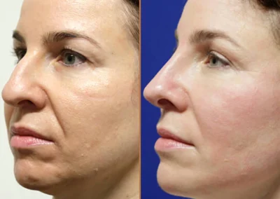 Rhinoplasty before and after photos by Sherber and Rad in Washington, DC