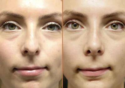 Rhinoplasty before and after photos by Sherber and Rad in Washington, DC