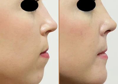 Rhinoplasty before and after photos by Sherber and Rad in Washington, DC