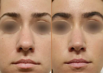 Rhinoplasty before and after photos by Sherber and Rad in Washington, DC