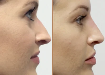 Rhinoplasty before and after photos by Sherber and Rad in Washington, DC