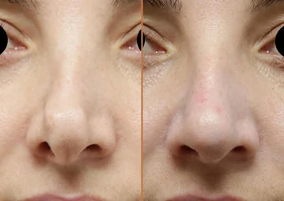 Rhinoplasty before and after photos by Sherber and Rad in Washington, DC