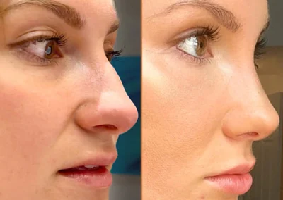 Rhinoplasty before and after photos by Sherber and Rad in Washington, DC