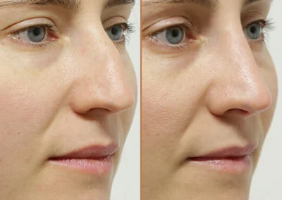 Rhinoplasty before and after photos by Sherber and Rad in Washington, DC