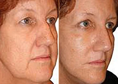 Rhinoplasty before and after photos by Sherber and Rad in Washington, DC