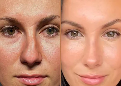 Rhinoplasty before and after photos by Sherber and Rad in Washington, DC