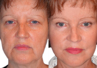 Female Eyelid Lift before and after photos by Sherber and Rad in Washington, DC