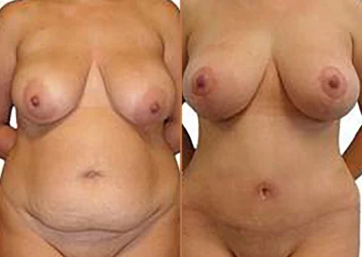 Mommy Makeover before and after photos by Sherber and Rad in Washington, DC