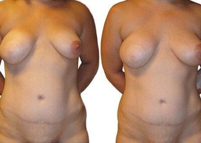 Love Handle Flap before and after photos by Sherber and Rad in Washington, DC