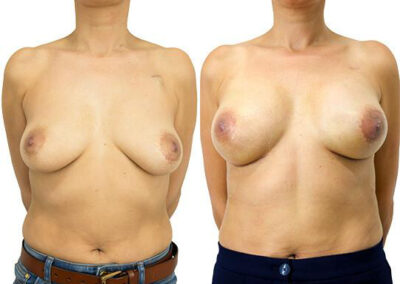 Implants before and after photos by Sherber and Rad in Washington, DC