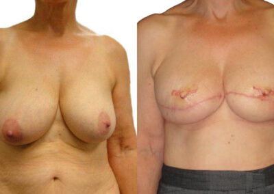 Nipple Reconstruction before and after photos by Sherber and Rad in Washington, DC