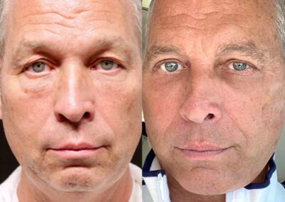 Male Rhinoplasty before and after photos by Sherber and Rad in Washington, DC