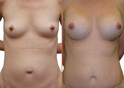 Mommy Makeover before and after photos by Sherber and Rad in Washington, DC