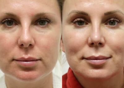 Female Eyelid Lift before and after photos by Sherber and Rad in Washington, DC