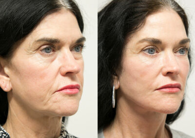 Facial Fat Transfer before and after photos by Sherber and Rad in Washington, DC