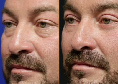 Male Eyelid Lift before and after photos by Sherber and Rad in Washington, DC