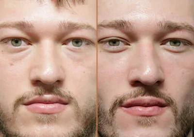 Male Eyelid Lift before and after photos by Sherber and Rad in Washington, DC