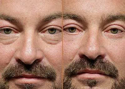 Male Eyelid Lift before and after photos by Sherber and Rad in Washington, DC