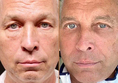 Male Facelift before and after photos by Sherber and Rad in Washington, DC