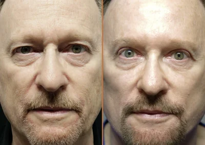 Male Facelift before and after photos by Sherber and Rad in Washington, DC