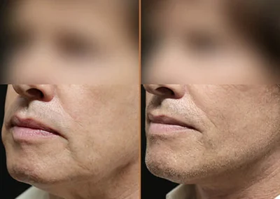 Male Facelift before and after photos by Sherber and Rad in Washington, DC