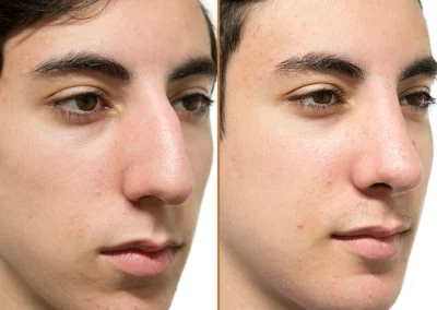 Male Rhinoplasty before and after photos by Sherber and Rad in Washington, DC