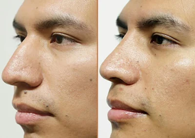Male Rhinoplasty before and after photos by Sherber and Rad in Washington, DC