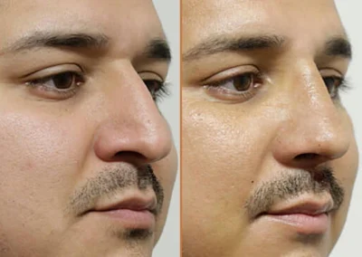 Male Rhinoplasty before and after photos by Sherber and Rad in Washington, DC