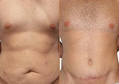 Male Tummy Tuck before and after photos by Sherber and Rad in Washington, DC