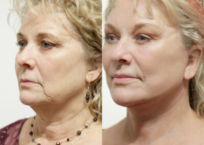 Neck Lift before and after photos by Sherber and Rad in Washington, DC