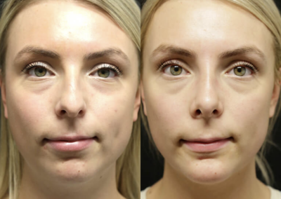 Rhinoplasty before and after photos by Sherber and Rad in Washington, DC