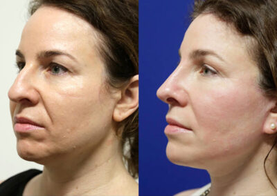 Neck Lift before and after photos by Sherber and Rad in Washington, DC