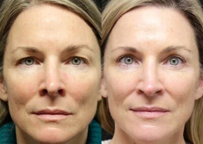 Female Eyelid Lift before and after photos by Sherber and Rad in Washington, DC