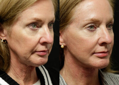 Neck Lift before and after photos by Sherber and Rad in Washington, DC